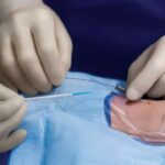 Como Se Preparar Para Cateterismo Cardiaco Dicas Importantes